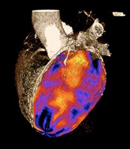 This image shows the areas of the heart receiving good blood flow (red) and other areas which are supplied by a blocked artery (darker colours). 