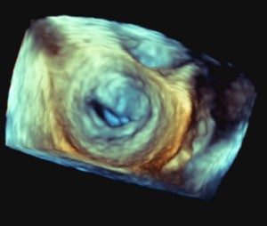 Mitral valve stenosis as seen by 3d Echocardiograph